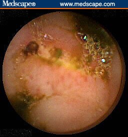 Capsule Endoscopy Procedure