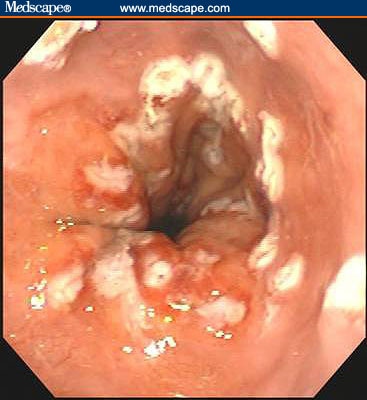 Capsule Endoscopy Procedure