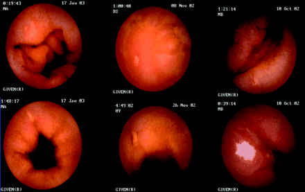 Capsule Endoscopy Procedure